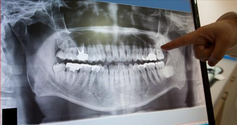 Vanwaar maakt mijn tandarts een röntgenfoto van mijn gebit?
